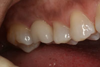 Dental Implants After Portage, MI