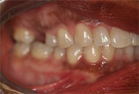 Dental Implants Before Portage, MI