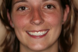 Teeth Whitening - After Portage, MI