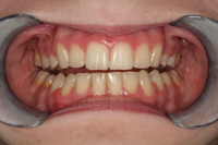 Before Shot - Teeth Whitening Portage, MI